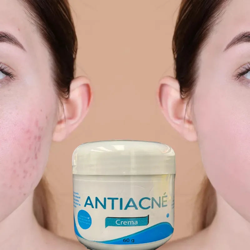 Crema Anti-acné 🌼 60 gr.